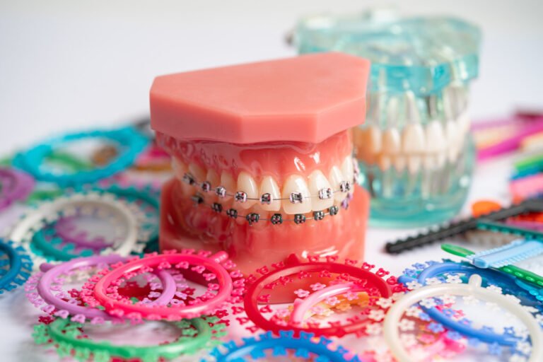 Capitol Dental Laboratory. Orthodontic ligatures rings and ties, elastic rubber bands on orthodontic braces