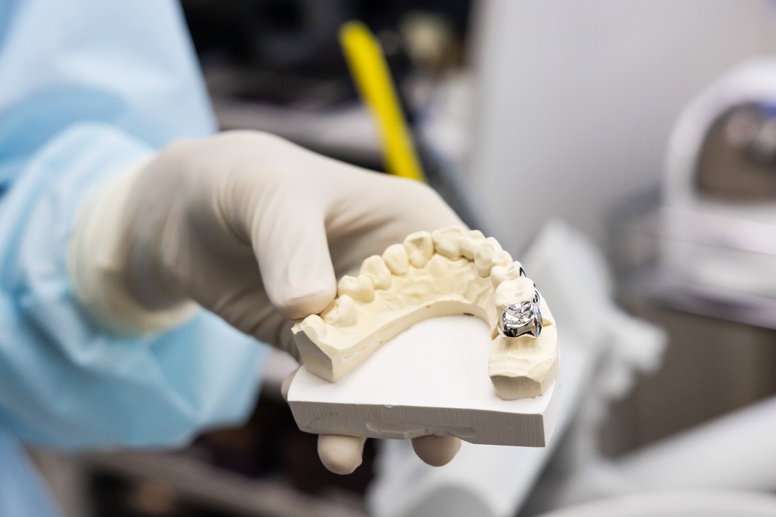 Capitol Dental Laboratory - Dentist holding dental prosthesis imprint with metal crown on molar tooth